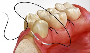 Швы в стоматологии