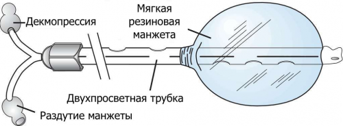 Декомпрессия кишечника при помощи зонда  Миллера - Эббота