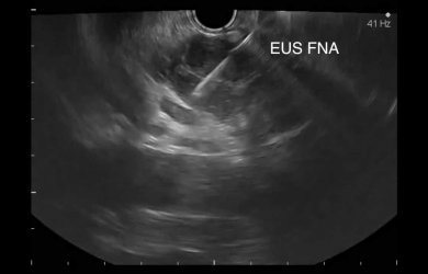 Образовательный центр WETLAB | Endosonographic image using a convection sensor at the time of puncture