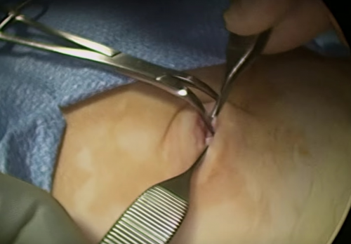 Laparoscopic appendectomy. Technique of execution.