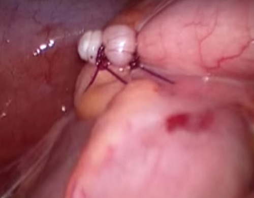 Laparoscopic appendectomy. Technique of execution.