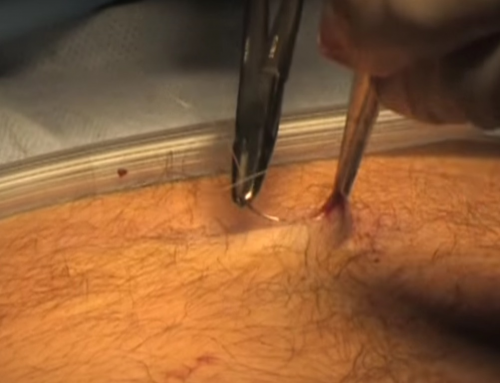 Laparoscopic appendectomy. Technique of execution.