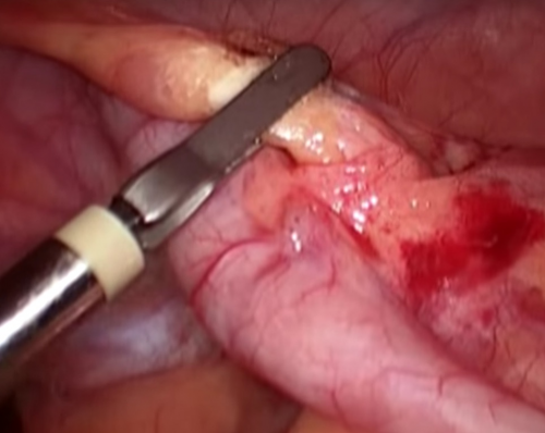 Laparoscopic appendectomy. Technique of execution.
