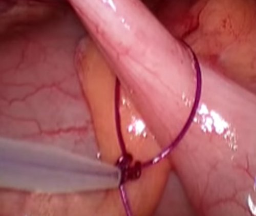 Laparoscopic appendectomy. Technique of execution.