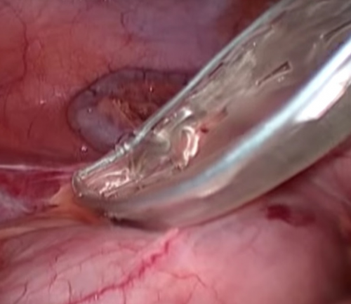Laparoscopic appendectomy. Technique of execution.
