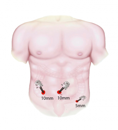 Laparoscopic appendectomy. Technique of execution.