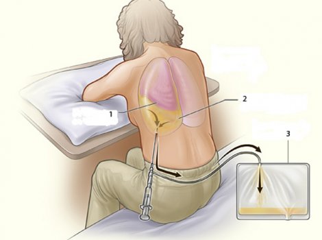 Образовательный центр WETLAB | Pleural puncture