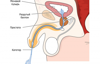 Катетеризация мочевого пузыря — Клиника «Ниармедик»